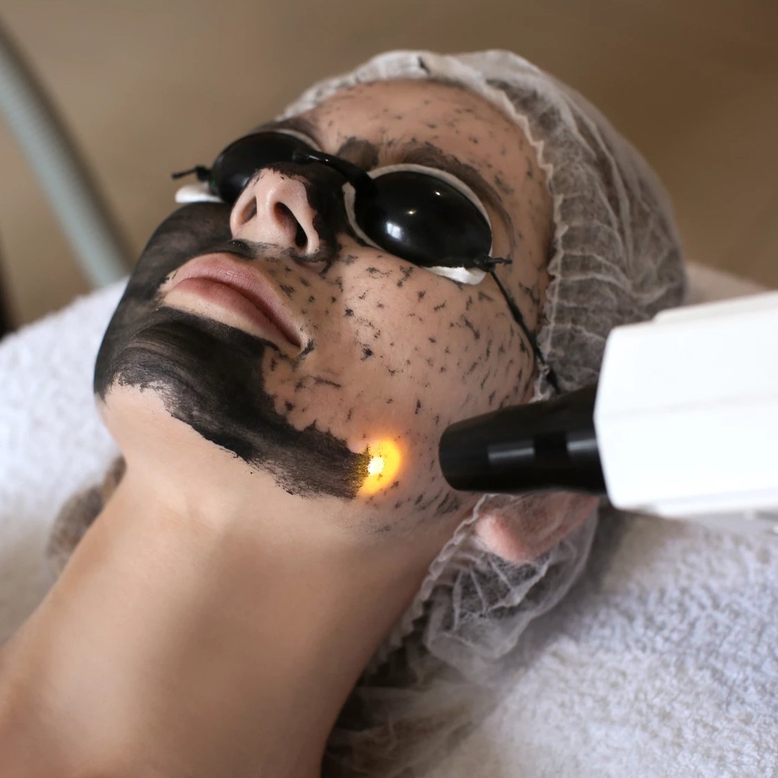 Carbon-Laser-Peeling